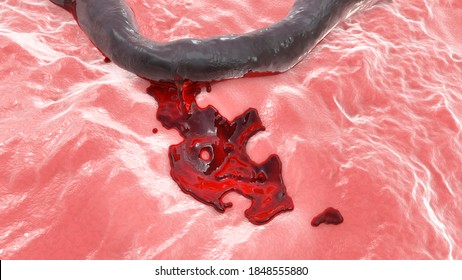 Hemorrhage, Blood Flowing From The Damaged Blood Vessel, 3D Illustration. Hemorrhagic Stroke, Traumatic Injury Or Other Diseases With Bleeding