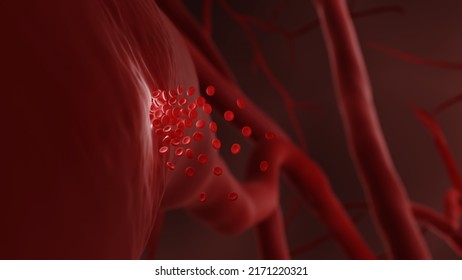 Hemorrhage Also Known As Internal Bleeding Can Lead To Hemorrhagic Stroke, 3d Illustration