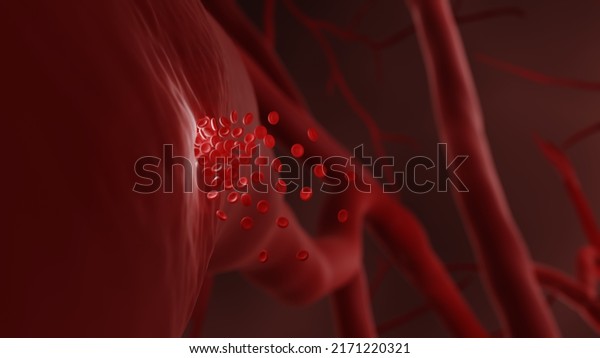 Hemorrhage also known as Internal Bleeding\
can lead to hemorrhagic stroke, 3d\
illustration
