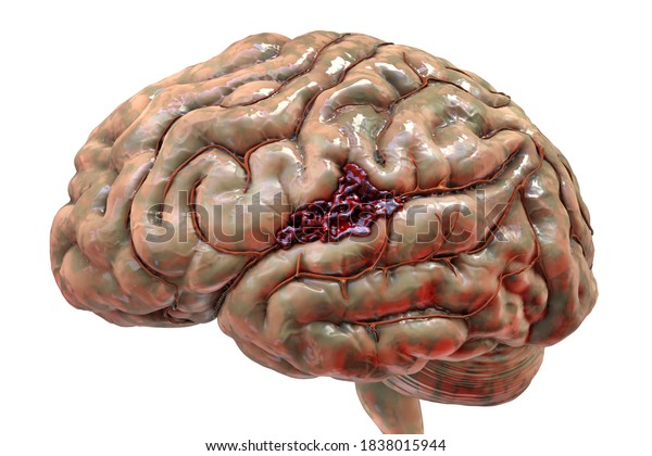 出血性脳卒中 3dイラスト 脳表面出血 脳血管からの出血 のイラスト素材