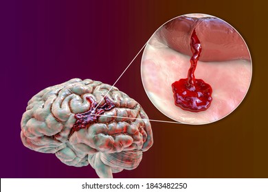 Hemorrhagic Stroke, 3D Illustration Showing Hemorrhage On The Brain Surface And Closeup View Of The Bleeding From A Brain Blood Vessel