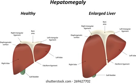 Hepatomegaly Images Stock Photos Vectors Shutterstock Hepatomegaly Images Stock Photos Vectors Shutterstock