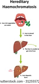 Hereditary Haemochromatosis Pathophysiology Stock Illustration ...