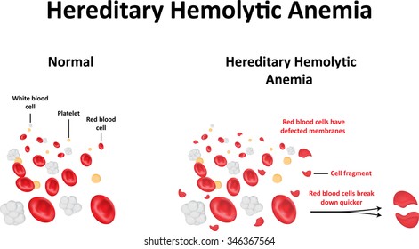Hereditary Hemolytic Anemia Diagram Stock Illustration 346367564 |  Shutterstock