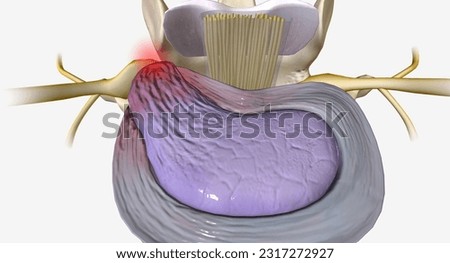 A herniated disc is a condition characterized by structural changes to an intervertebral disc 3D rendering Stockfoto © 