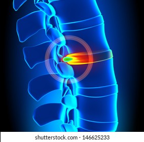 Herniated Disc Degeneration - Spine problem