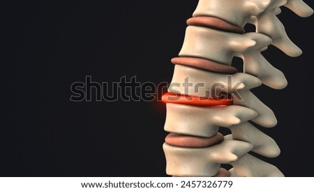 Herniated disc in the human spine 3d illustration