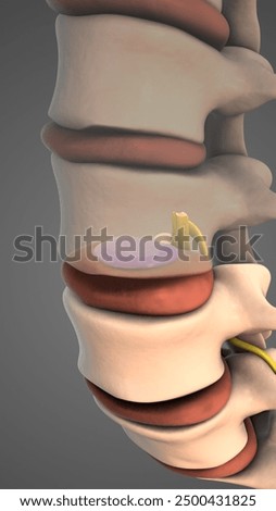 Herniated disc in lumbar vertebrae 3d illustration