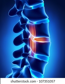 Herniated disc with pressure on spinal cord