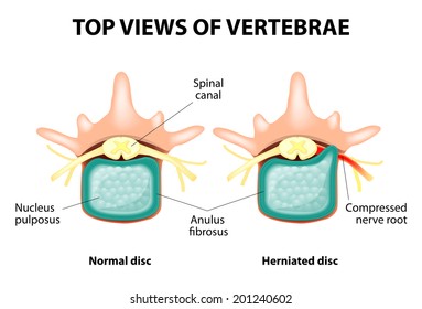 Herniated Disc. Prolapse of intervertebral disc closeup.