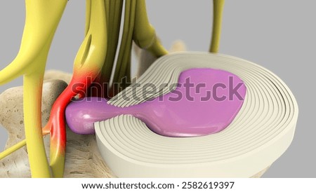 Herniated Disc Sciatic Pinched Nerve Pain