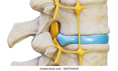 Herniated Disc Spinal Nerve Compression 3d Stock Illustration ...