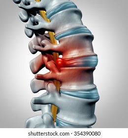 Herniated disk concept and spine pain diagnostic as a human spinal system symbol as medical health problem and anatomy symbol with the skeletal bone structure and intervertebral discs closeup.