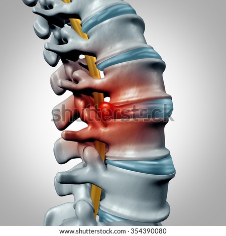 Herniated disk concept and spine pain diagnostic as a human spinal system symbol as medical health problem and anatomy symbol with the skeletal bone structure and intervertebral discs closeup. Stock photo © 