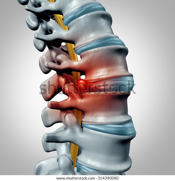 Herniated disk concept and spine pain diagnostic\
as a human spinal system symbol as medical health problem and\
anatomy symbol with the skeletal bone structure and intervertebral\
discs closeup.