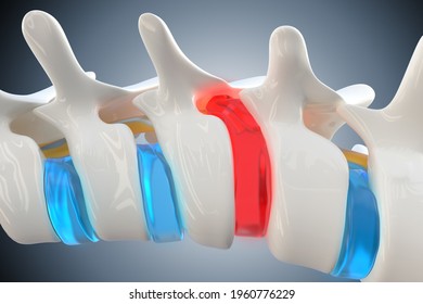 Herniated, Prolapsed Disk Compresses The Spinal Cord Causing Back Pain And Other Health Problems, 3d Illustration