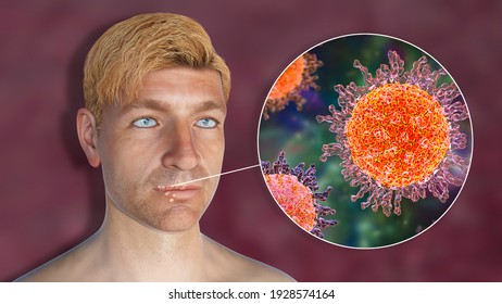 Herpes Labialis Known Cold Sores 3d Stock Illustration 1928574164 ...