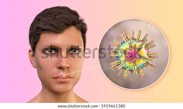 Herpes labialis, also known as cold sores,\
3D illustration showing lesions on the man\'s lips caused by herpes\
simplex virus and closeup view of the\
virus
