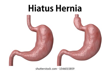 370 Hernia 3d Images, Stock Photos & Vectors | Shutterstock