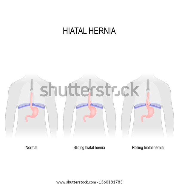 Hiatal Hernia Vector Diagram Different Types Stock Illustration 1360181783