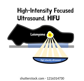 High Intensity Focused Ultrasound, Gynecologist