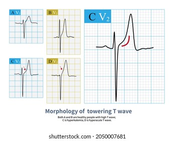 High T Waves Can Appear In Normal People. They Are Common In Healthy Men, Especially Those Who Like Exercise And Slow Resting Heart Rate. Do Not Misdiagnose Them As Hyperkalemia And MI.