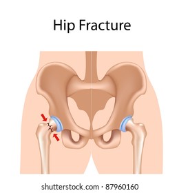 Hip Fracture