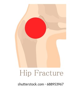 Hip Fracture Icon. Cartoon Illustration Of Hip Fracture  Icon For Web Isolated On White Background