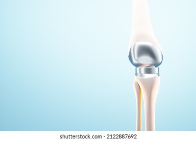 Hip Implant Medical Poster, Image Of The Bones Of The Knee, Artificial Joint In The Knee. Arthritis, Inflammation, Fracture, Cartilage,. Copy Space, 3D Illustration, 3D Render