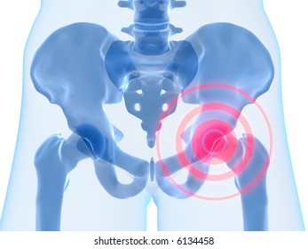 Hip Inflammation Stock Illustration 6134458 | Shutterstock