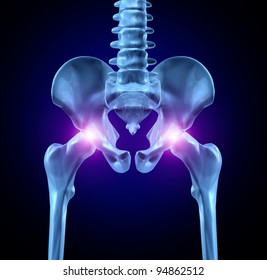 ヒトの骨格の前頭の接写マクロのx線医療イラストを用いた股関節痛で 慢性疾患としての痛みのある部分と 股関節置換手術が必要な骨の損傷 のイラスト素材 Shutterstock