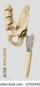 Hip Joint Replacement, Artificial Joint 3d Illustration