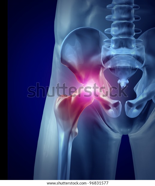 Hip Pain Inflamed Joint Xray Medical Stock Illustration 96831577