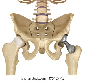 骨盤骨に取り付けられた人工股関節置換インプラント 医学的に正確な3dイラスト のイラスト素材