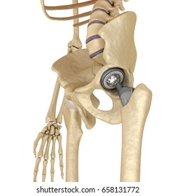 2,083 Artificial hip Images, Stock Photos & Vectors | Shutterstock