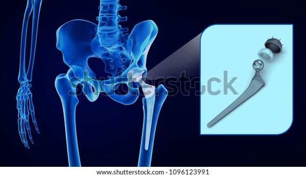 骨盤骨に取り付けられた人工股関節置換インプラント X線写真 医学的に正確な3dイラスト のイラスト素材