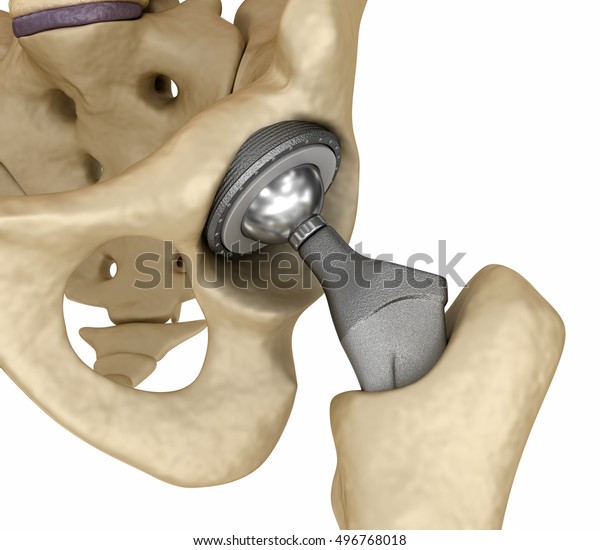 Hip Replacement Implant Installed Pelvis Bone Stock Illustration ...