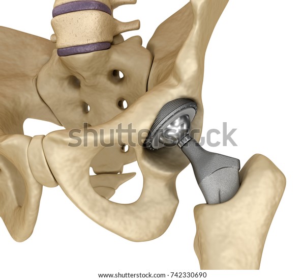 髋关节置换植入物安装在骨盆骨 医学准确的3d 插图库存插图742330690