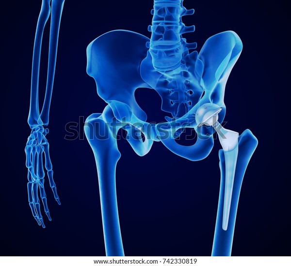 Hip replacement\
implant installed in the pelvis bone. X-ray view. Medically\
accurate 3D illustration\
