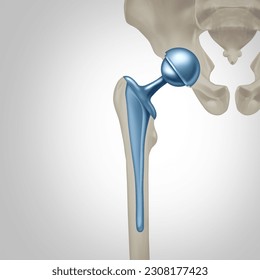 Hip Replacement Surgery concept as an artificial joint or prosthesis with orthopedic surgery inserting a metal ball and socket to replace a damaged by disease Femure joint in a 3D illustration style.
