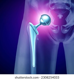 Hip Replacement Surgery concept as an artificial joint or prosthesis with orthopedic surgery inserting a metal ball and socket to replace a damaged by disease Femure joint in a 3D illustration style.