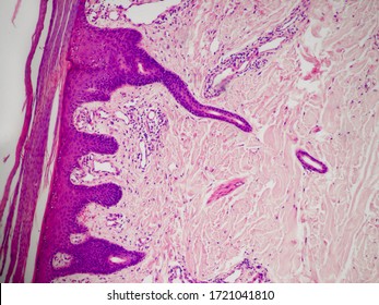 Histology Preparation Of Psoriasis On The Human Skin