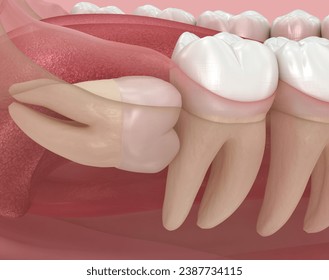 Horizontal impaction of Wisdom tooth. Medically accurate tooth 3D illustration