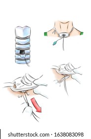 Tracheostomy Sutures