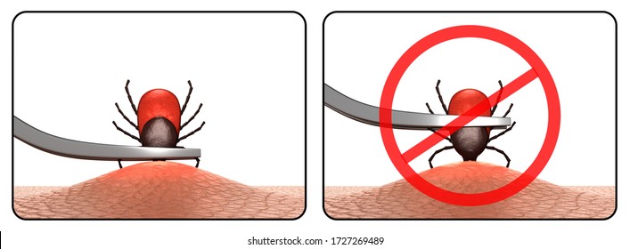 Tick Removal Images, Stock Photos & Vectors | Shutterstock