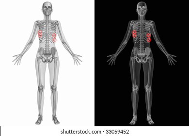 Human Anatomy - Broken Ribs