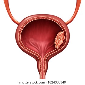 Human Bladder Cancer As A Urinary Anatomical Organ Disease And Malignant Cells Concept As A 3D Illustration Cutaway Of Body Anatomy.