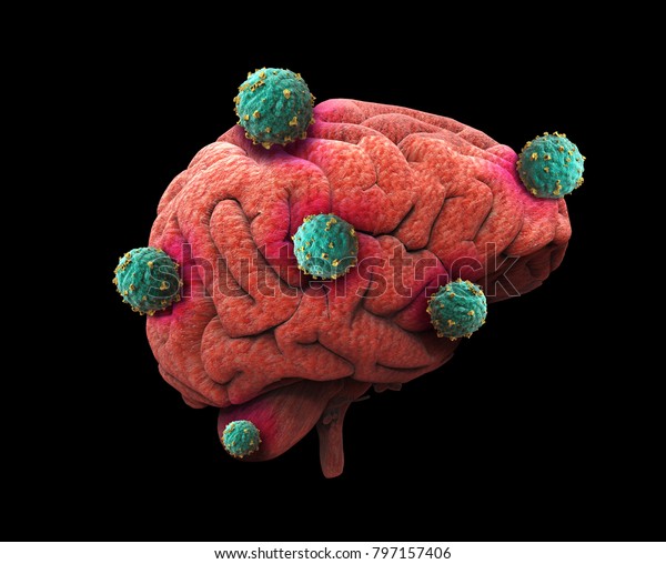 Human Brain Cancer Cells Spreading Growing Stock ...