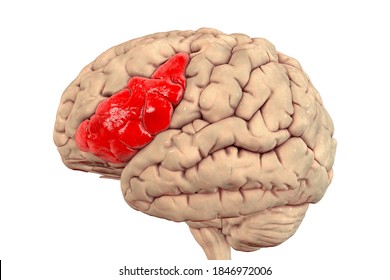 Human Brain With Highlighted Inferior Frontal Gyrus, 3D Illustration. It Is A Part Of The Prefrontal Cortex And The Location Of Broca's Area, Involved In Language Processing And Speech Production