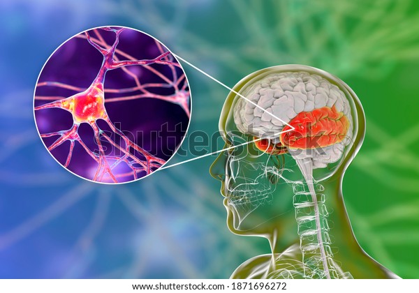 Human\
brain with highlighted temporal lobe and close-up view of pyramidal\
neurons found in temporal cortex, 3D\
illustration